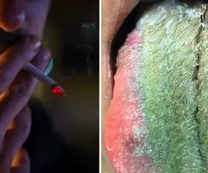 (عکس 14+) زبان این مرد سیگاری سبز شد و مو درآورد؛ بدبخت زبونشم ژیلت لازم شد!