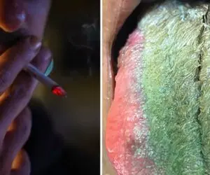 (عکس 14+) زبان این مرد سیگاری سبز شد و مو درآورد؛ بدبخت زبونشم ژیلت لازم شد!