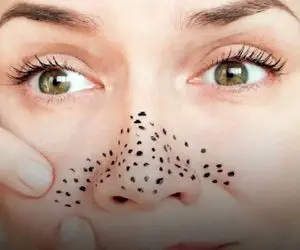 از بین بردن دون دون های سیاه بینی؛ امتحان نمیکردمش باورم نمیشد تخم مرغ این کارو کنه