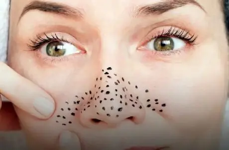 از بین بردن دون دون های سیاه بینی؛ امتحان نمیکردمش باورم نمیشد تخم مرغ این کارو کنه