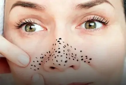 از بین بردن دون دون های سیاه بینی؛ امتحان نمیکردمش باورم نمیشد تخم مرغ این کارو کنه