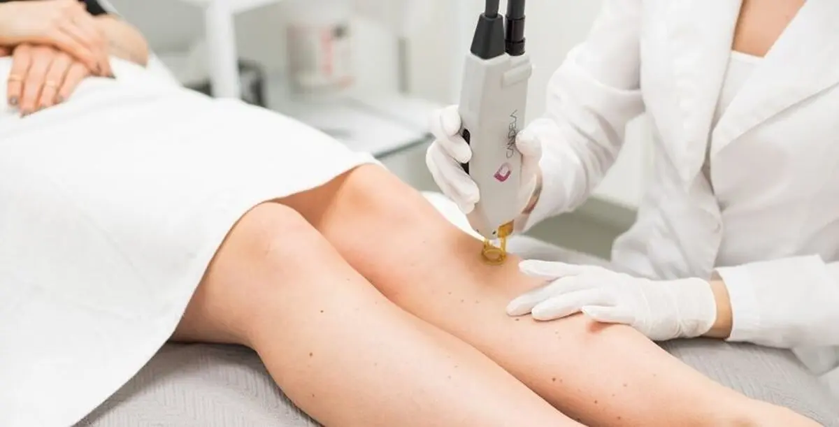 laser-hair-removal-5