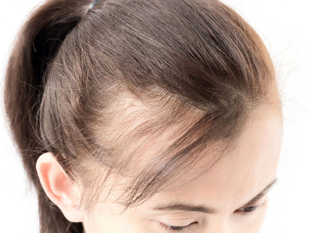 Key-facts-on-Androgenic-Alopecia-in-women1