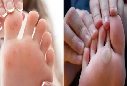 از بین بردن میخچه و پینه بدون درد در عرض 2 روز و در خانه؛ با مواد ارزون و در دسترس