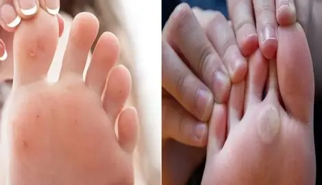 از بین بردن میخچه و پینه بدون درد در عرض 2 روز و در خانه؛ با مواد ارزون و در دسترس