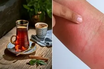 درمان سوختگی دست و صورت با چای / اگه موقع آشپزی زیاد با روغن و آب جوش میسوزی خوراکته