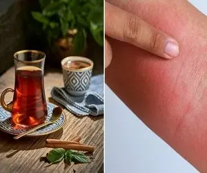 درمان سوختگی دست و صورت با چای / اگه موقع آشپزی زیاد با روغن و آب جوش میسوزی خوراکته
