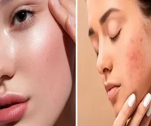 ترفند های خانگی برای رفع جوش؛ با اینا بدون فیلتر صورتت از آینه هم صاف تر میشه عشق کنی