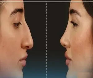 بهترین دکترهای بینی در تهران / توریست میاد ایران که بره پیش اینا دماغشو عمل کنه بیستن