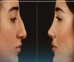 بهترین دکترهای بینی در تهران / توریست میاد ایران که بره پیش اینا دماغشو عمل کنه بیستن