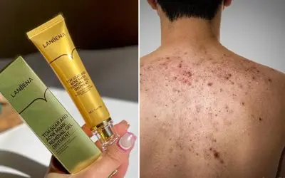 روش طبیعی از بین بردن جای جوش پشت کمر / پماد های موثر و ترکیبات خونگی برای محو لک