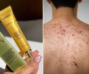 روش طبیعی از بین بردن جای جوش پشت کمر / پماد های موثر و ترکیبات خونگی برای محو لک