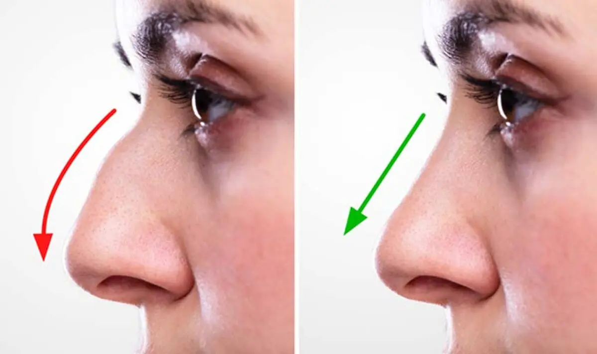 patient-after-septorhinoplasty-Nasal-Sinus-Surgery