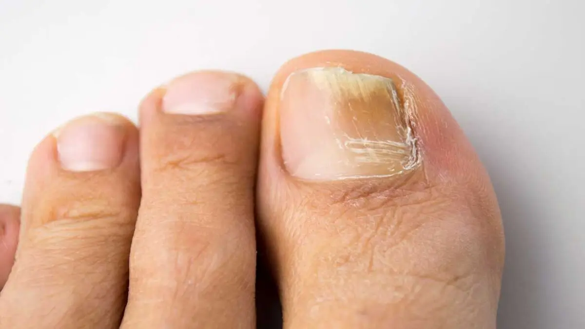 Get-Rid-of-Nail-Fungus-www.koorook.com-21