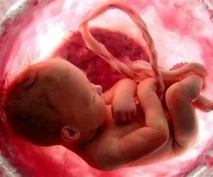 انجام ۸۰ درصد سقط‌های قانونی در تهران