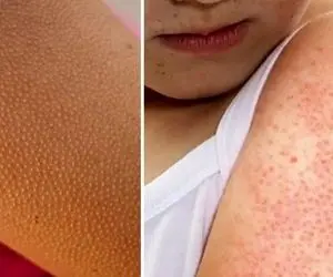 ریخت بدنت زشت شده واسه پوست مرغی که داری / بهترین روش‌های درمان خونگی این عارضه