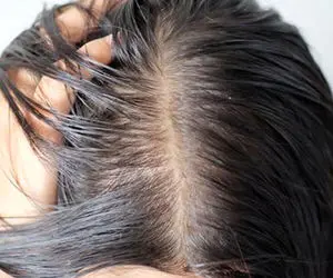 روش های از بین بردن موهای چرب چیست؟