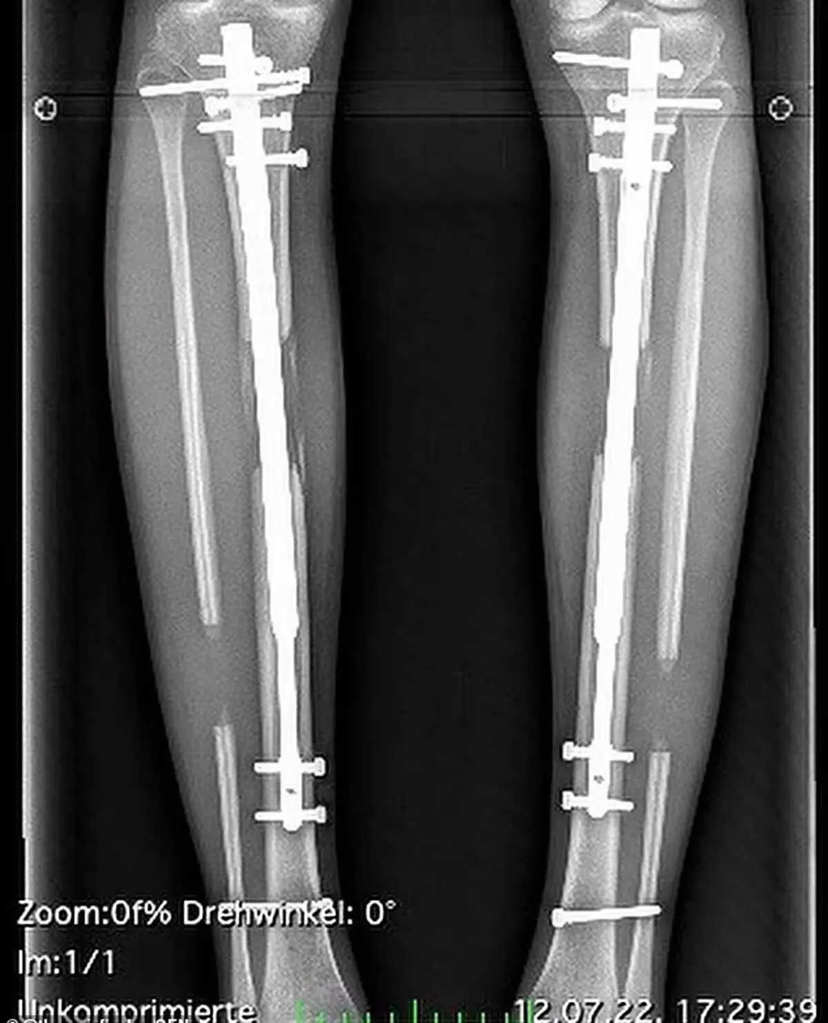 74908641-12464611-Doctors_inserted_adjustable_telescopic_rods_into_her_shinbones_a-a-6_1693516147239
