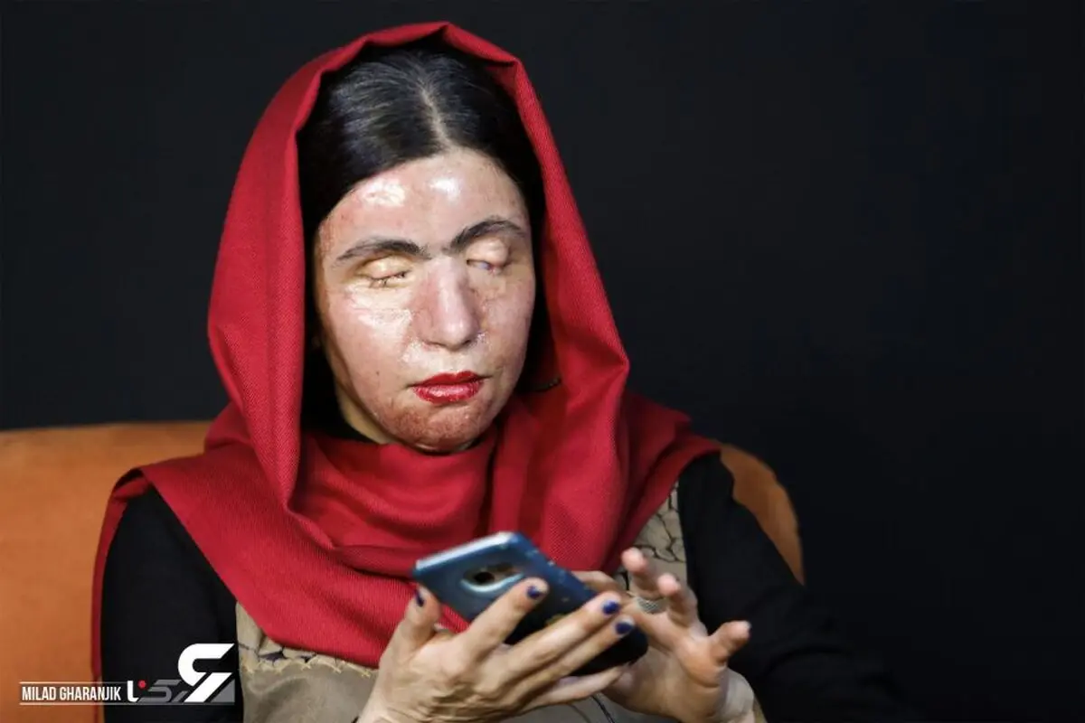 معصومه ی 27 ساله بی چهره شد!/صحبت با زن بی چهره ی ایران!