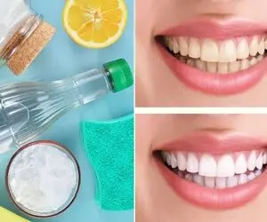 سفید کردن دندون ها با مواد طبیعی در عرض یکبار استفاده / لبخند براقت رو بی دردسر بساز