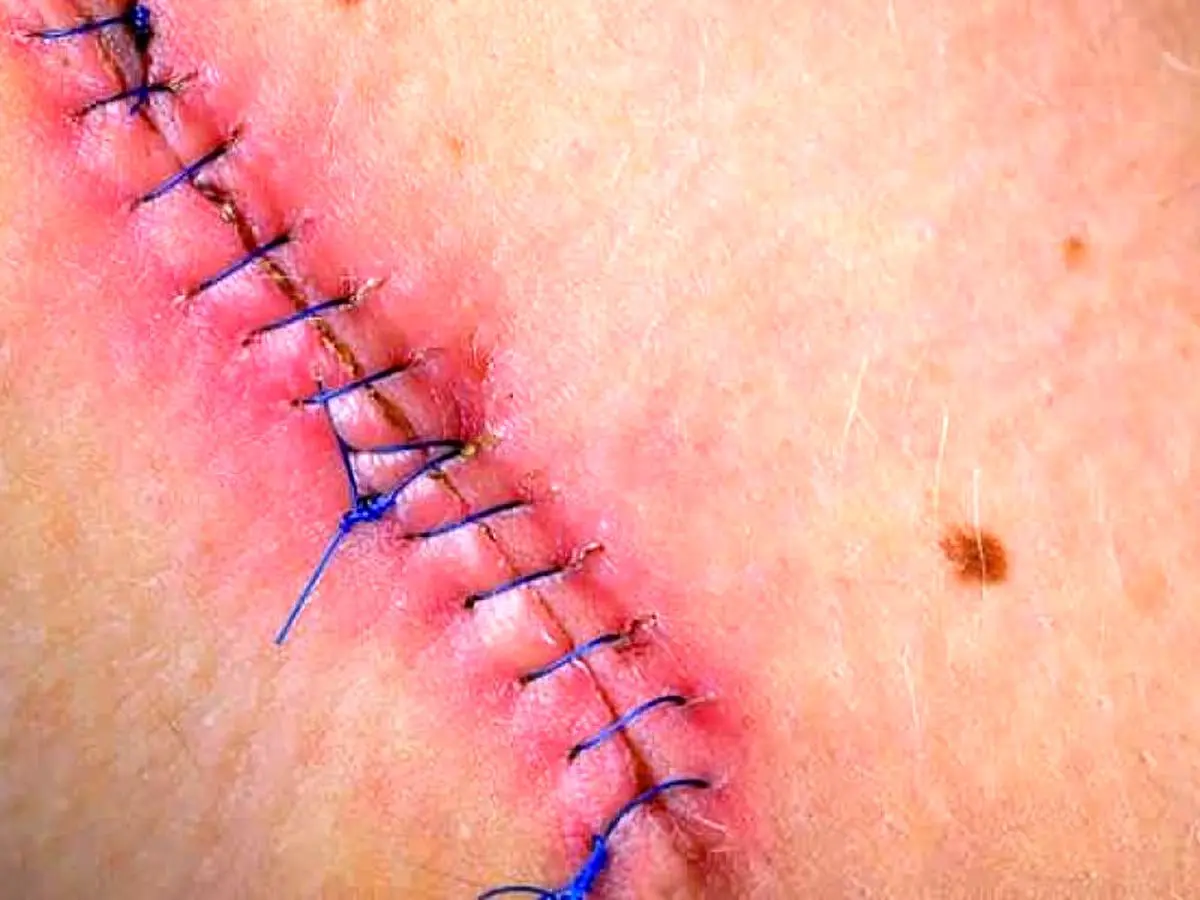 موثر ترین پمادهای ترمیم کننده جای زخم و بخیه؛ مهم نیست صورت باشه یا بدن سریع خوب میشه