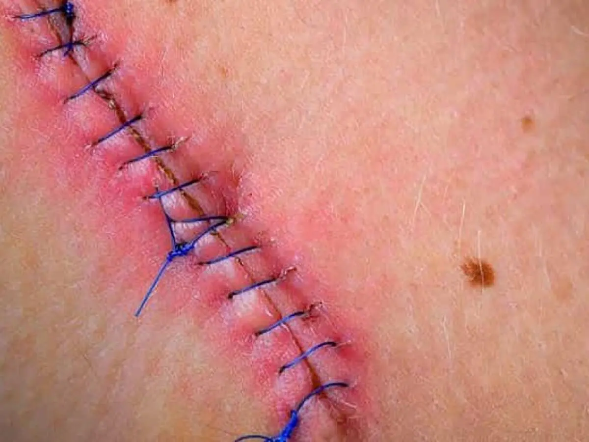 Photo-of-infected-suture-r69yybkv5qnfh5c6xs44gvhc5pd6aqv07ovrcpeflc