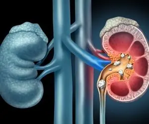 عادت‌های غلطی که کلیه شما را سنگ‌ساز می‌کند!