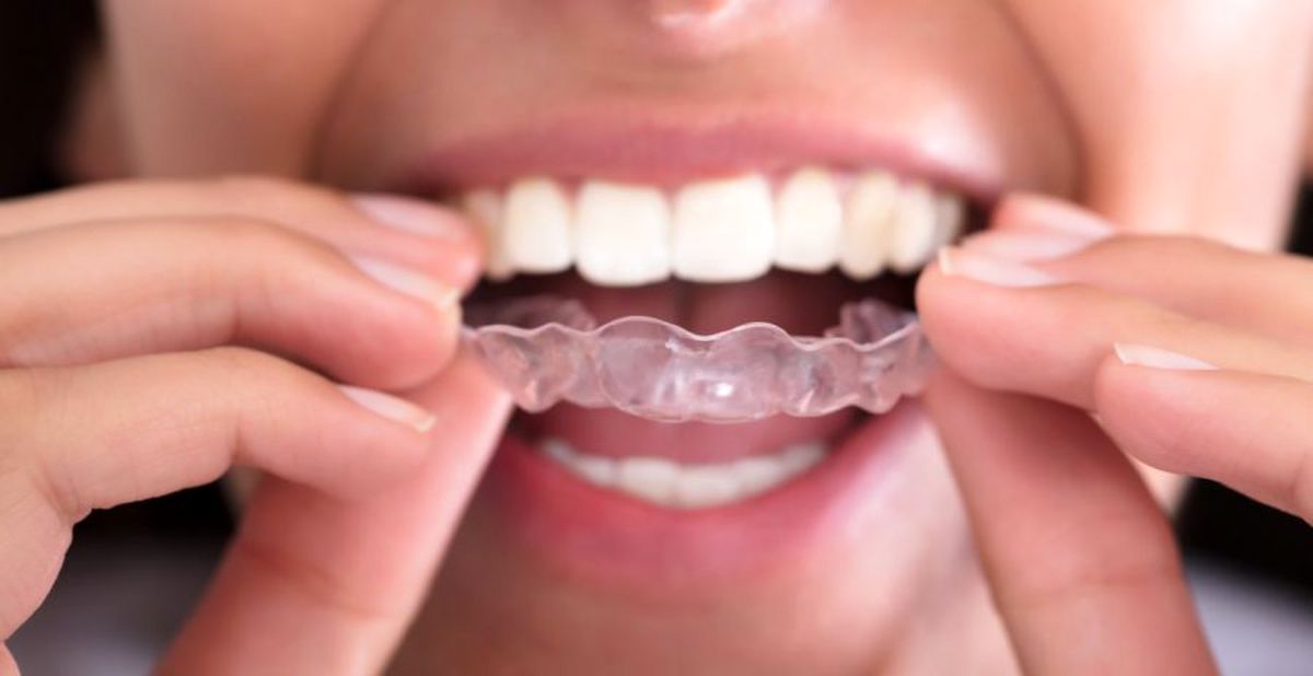 دندان قروچه چیست؟ علت ایجاد و بهترین درمان های خانگی برای آن کدام است؟