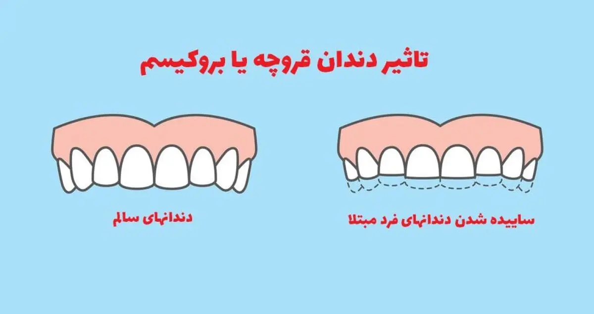 دندان قروچه چیست؟ علت ایجاد و بهترین درمان های خانگی برای آن کدام است؟