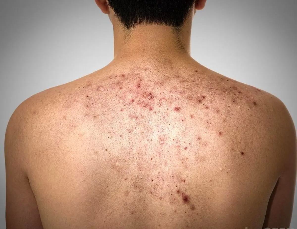 روش طبیعی از بین بردن جای جوش پشت کمر / پماد های موثر و ترکیبات خونگی برای محو لک روش طبیعی از بین بردن جای جوش پشت کمر / پماد های موثر و ترکیبات خونگی برای محو لک