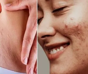 ارزون ترین پماد؛ اگه هیچ پولی نداری اینارو از داروخانه بگیر/لک بارداری ترک ران و آکنه