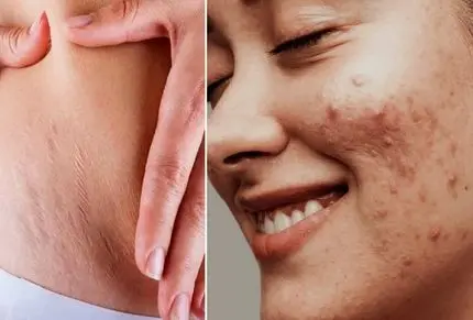 ارزون ترین پماد؛ اگه هیچ پولی نداری اینارو از داروخانه بگیر/لک بارداری ترک ران و آکنه