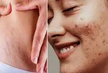 ارزون ترین پماد؛ اگه هیچ پولی نداری اینارو از داروخانه بگیر/لک بارداری ترک ران و آکنه