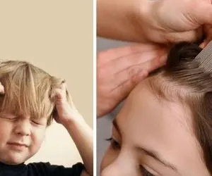 موثرترین روش های درمان خانگی شپش سر / راهکارهای مفید برای از بین بردن شپش