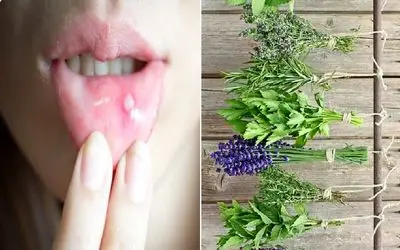 از بین بردن آفت دهان با روش های طبیعی؛ دوبار این کار رو کن فرداش یادت نمیاد آفت داشتی