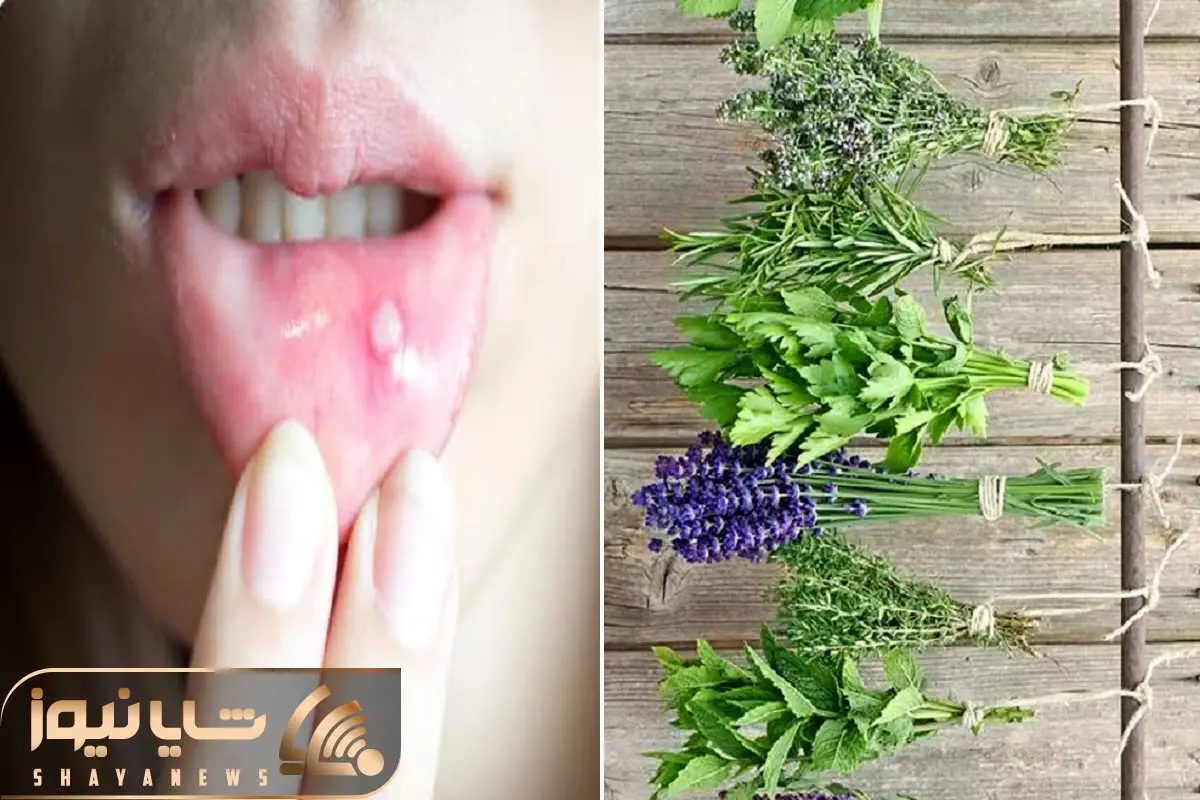 از بین بردن آفت دهان با روش های طبیعی؛ دوبار این کار رو کن فرداش یادت نمیاد آفت داشتی