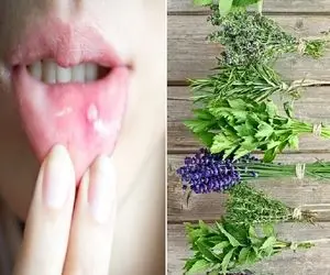 از بین بردن آفت دهان با روش های طبیعی؛ دوبار این کار رو کن فرداش یادت نمیاد آفت داشتی