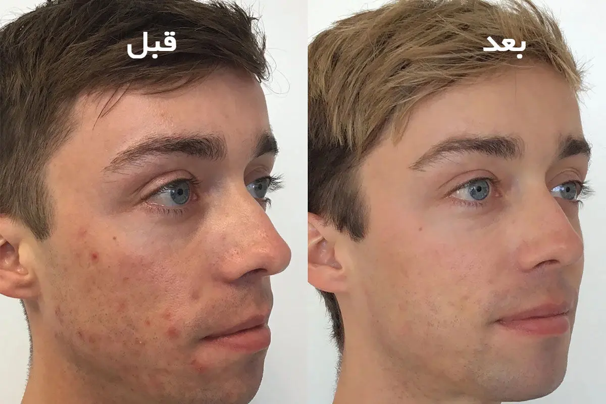 قبل و بعد از کرم ضد لک - تصویر 2