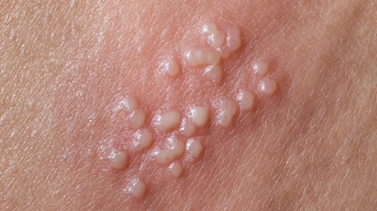 herpes11-1140x640