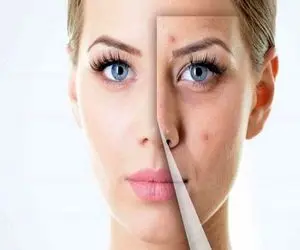 ضد لک قوی و کورتون طبیعی برای رفع لک و جای آکنه؛ با این دمنوش ها پوستتو بیمه کن!