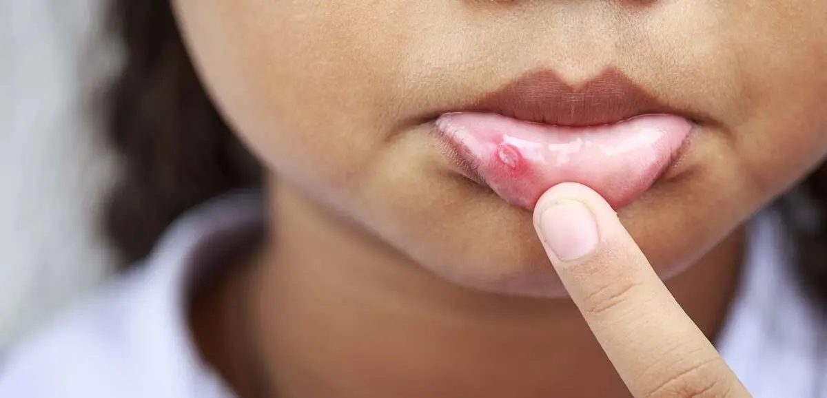 Canker-Sore