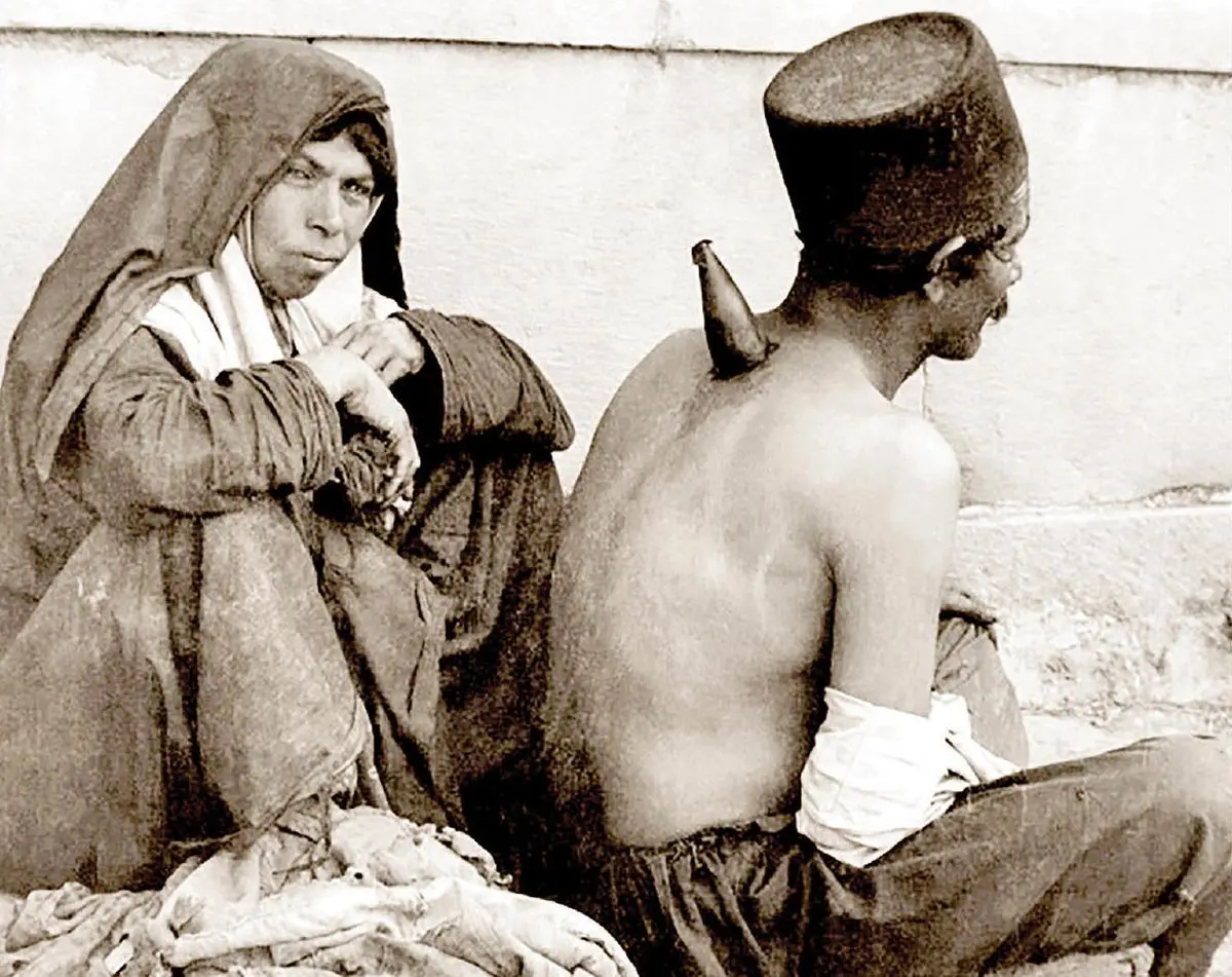 حجامت با شاخ گاو در قاجار