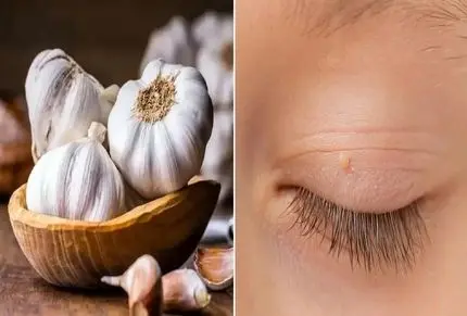 از بین بردن اسکین تگ همان منگوله پوستی ؛ بدون هزینه برای لیزر با مواد طبیعی و در خانه