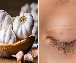 از بین بردن اسکین تگ همان منگوله پوستی ؛ بدون هزینه برای لیزر با مواد طبیعی و در خانه