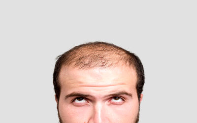 آلوپسی یا ریزش سکه‌ای مو، از علائم تا روش‌های درمانی