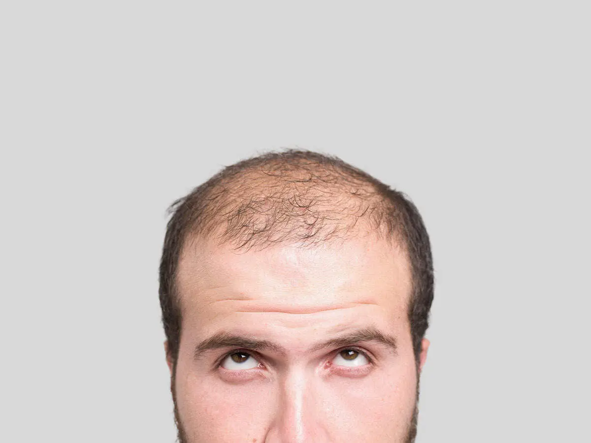 baldness_istock