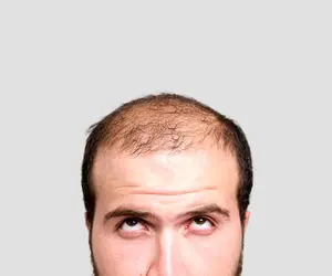 آلوپسی یا ریزش سکه‌ای مو، از علائم تا روش‌های درمانی