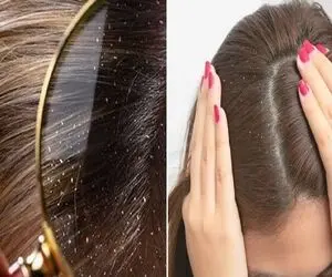جنگ با شوره سر اونم با راه های طبیعی و خونگی؛ با سرکه با هر خارش و پوسته ای خدافظی کن