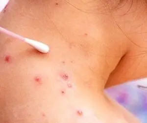 آبله میمون از طریق هوا منتقل می‌شود؟