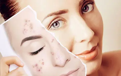 درمان های موثر خانگی لک صورت و بدن چیست؟